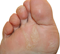 callus foot