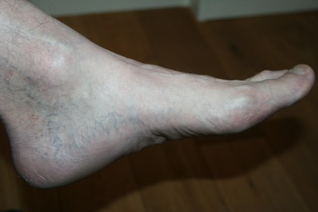 athlete foot birkenstock