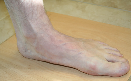 birkenstock foot pain