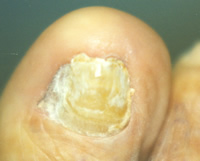 Thickened Toe Nail