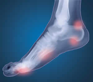 The Orthotic Group - foot pain